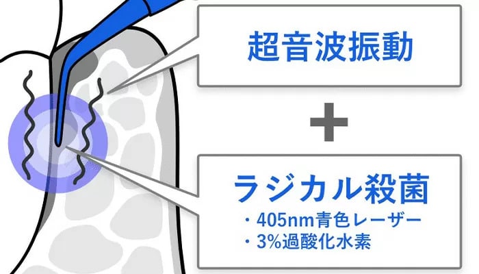 世田谷区の歯医者　尾山台駅前歯医者　虫歯について