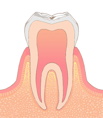 世田谷区の歯医者　尾山台駅前歯医者　虫歯の進行段階と治療法　C0：脱灰