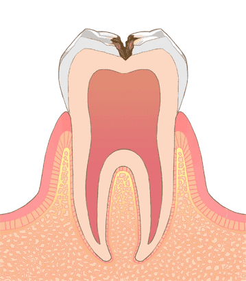 世田谷区の歯医者　尾山台駅前歯医者　虫歯の進行段階と治療法　C2：象牙質の虫歯