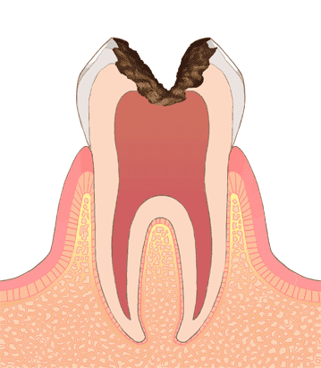 世田谷区の歯医者　尾山台駅前歯医者　虫歯の進行段階と治療法　C3：神経に達した虫歯